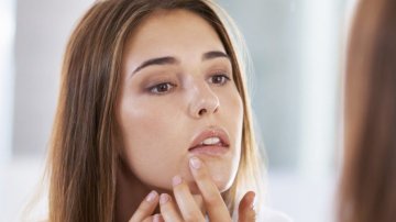 Tips and Tricks to Blow Off  Stubborn Acne In Your Chin