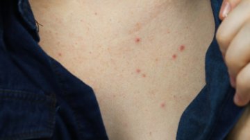 How To Get Rid Of Chest Acne? Try With Those Simple Tips!