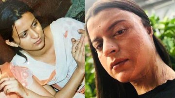 Kangana Ranaut’s Sister Rangoli Chandel Opens Up On Her Horrifying Acid Attack Story