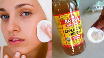 Apple Cider Vinegar For Face Pigmentation Detailed Remedy Instructions