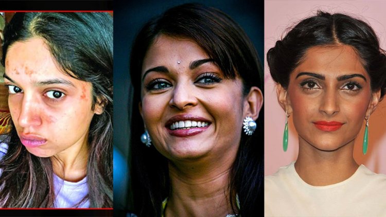 Top 5 Bollywood Actresses With Bad Skin – They Are Not That Flawless