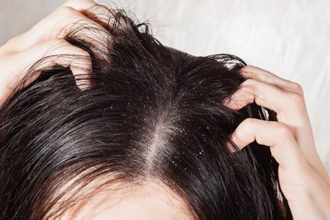 10 Dandruff Surprising Reasons Why Your Hair Is Gr