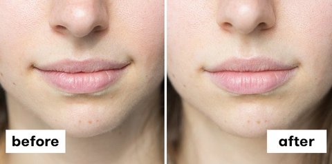 Before And After Lips