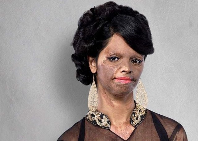 A Brave Acid Attack Victim Who Is Presenting Hope