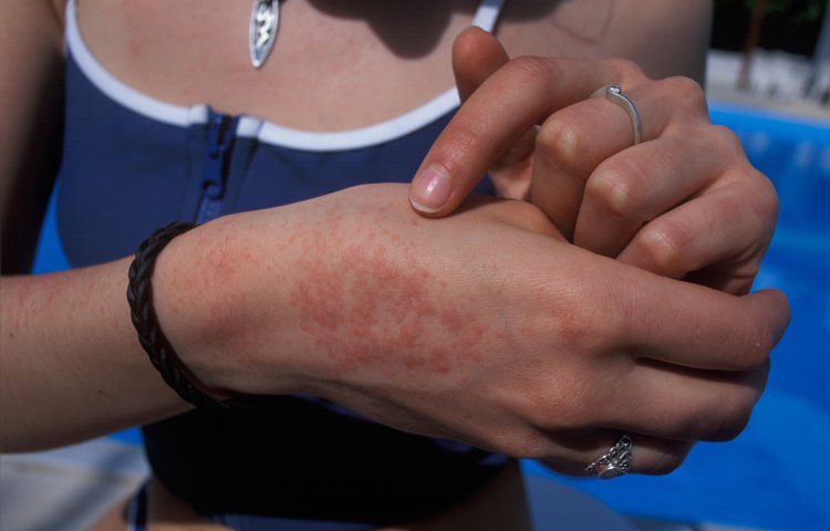 Káº¿t quáº£ hÃ¬nh áº£nh cho Cool down with a water spray to get away from prickly heat