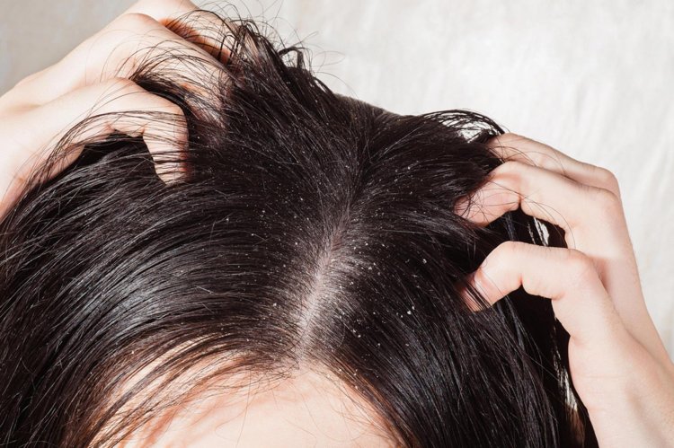 10 Dandruff Surprising Reasons Why Your Hair Is Gr