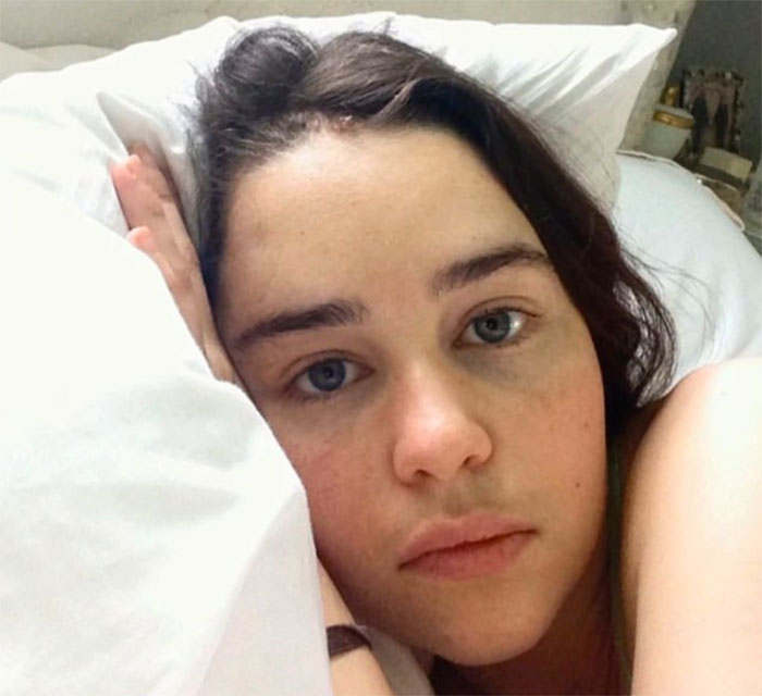 Brain Surgery Aneurysm Emilia Clarke