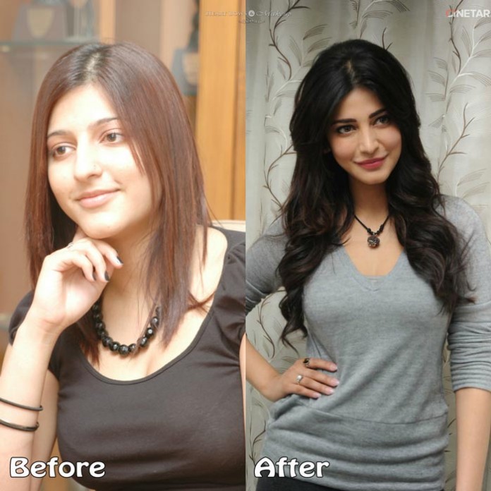 Plastic Surgery Shruti Hassan