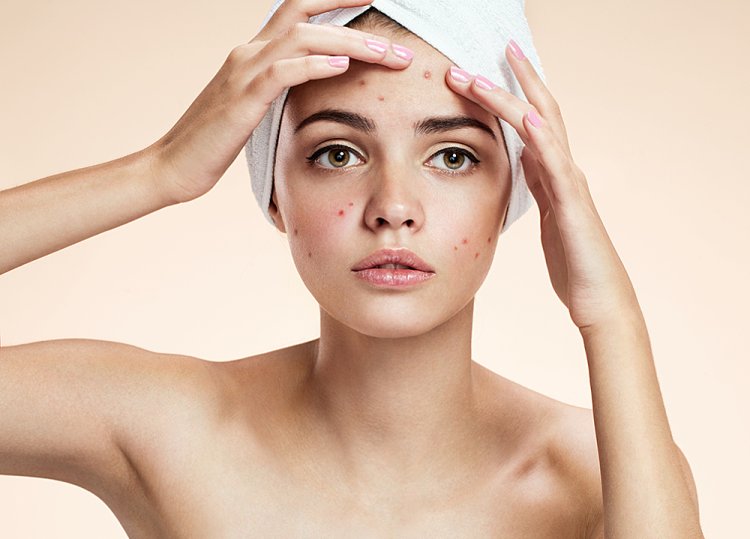Woman With Acne