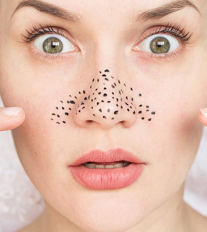 how to get rid of blackheads on nose