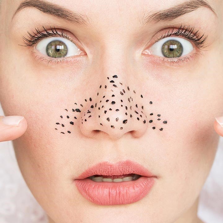 what-causes-blackheads