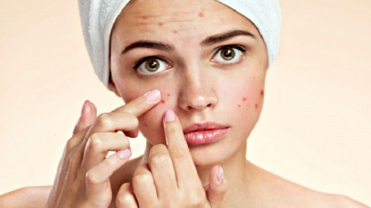 Acne Shutterstock 770x470ll