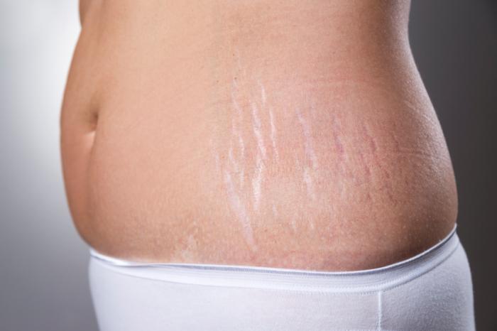 Stretch Mark Treatments On Tummy