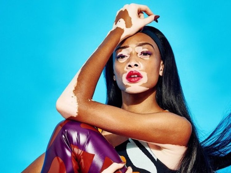 Winnie Harlow