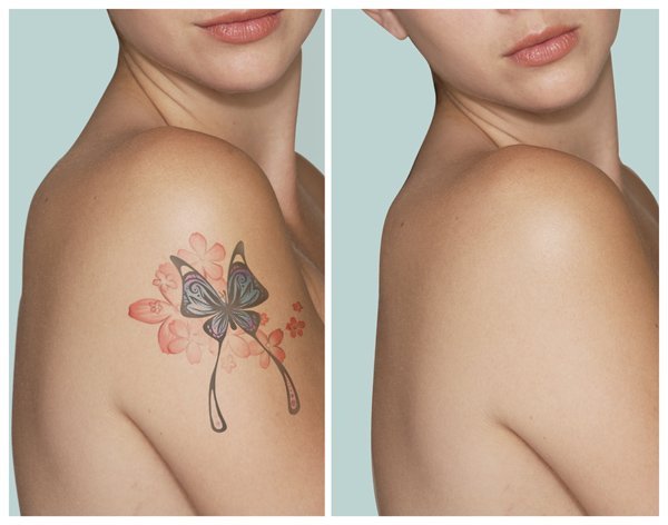 Natural Ways To Remove A Tattoo