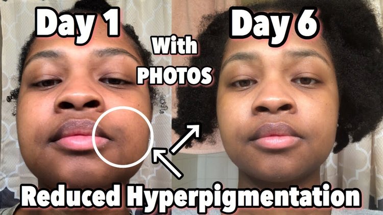 Apple Cider Vinegar Hyperpigmentation Before And After