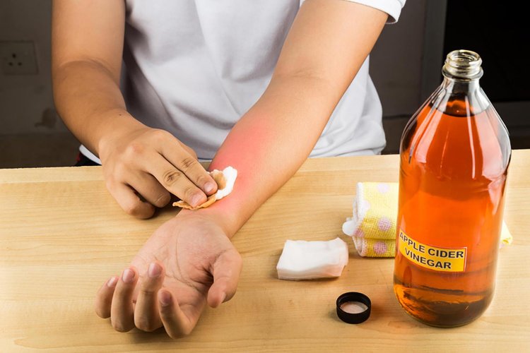 Apple Cider Vinegar Heal Sunburn