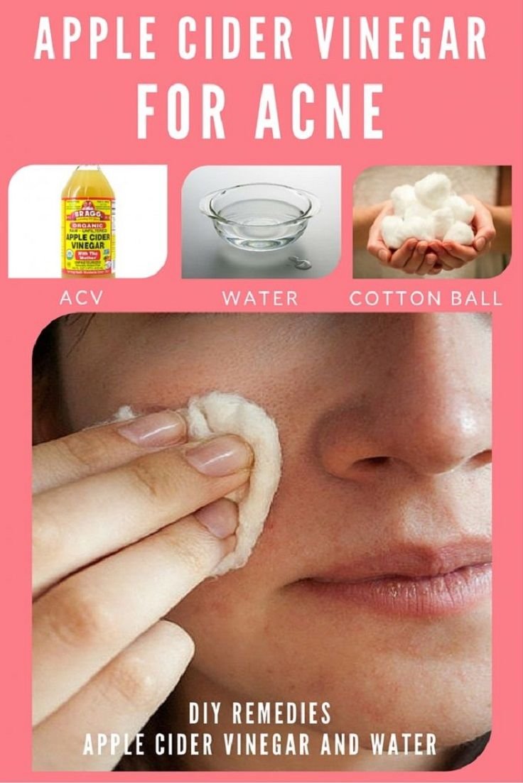 Apple Cider Vinegar Treat Acne