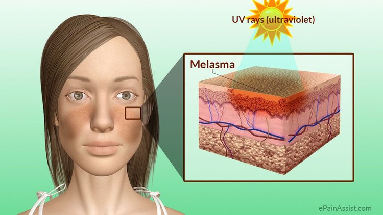 Cause Of Melasma