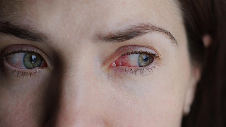Pink Eye