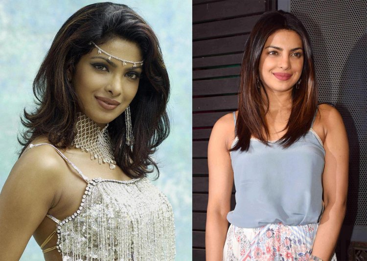 Priyanka Chopra Before And After Skin Surgery